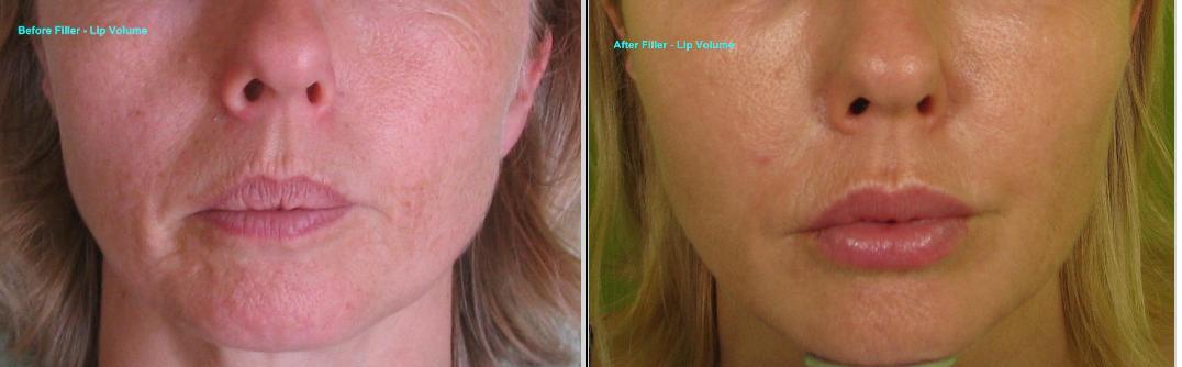 Dermal Fillers Before and After Gallery - Live Young Medical