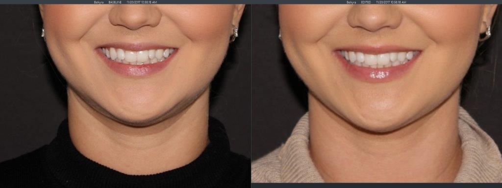 B+A Belkyra- front.jpg