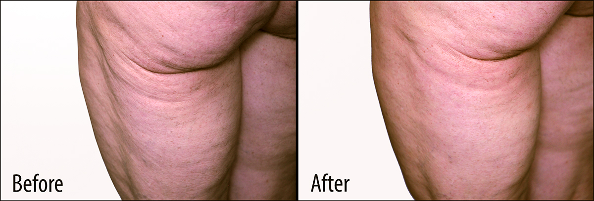 Cellulite Profound images