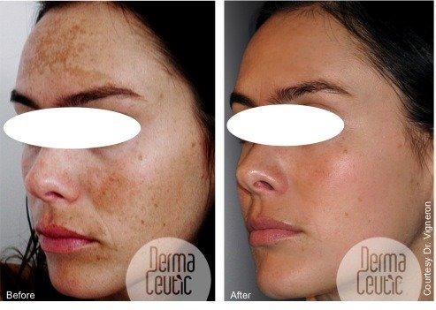 Glycolic Skin Peels &amp; Microdermabrasion Treatments