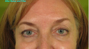 02Soft-Lift-Full-face-441-C- 2