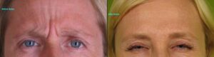 Botox-4-W-e1347487519967