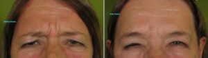 Botox-84-M-e1347487528423