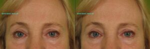 Botox-Brow-lift-257-M-e1347487544550