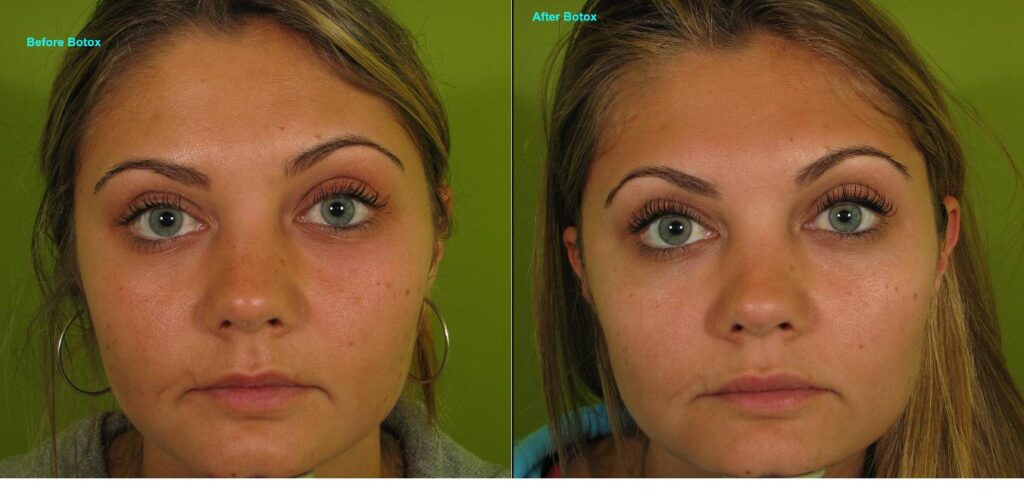 Botox-Brow-lift-384-W