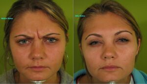 Botox for frown lines