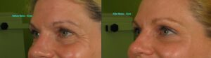 Botox reduces the fine lines around the eyes