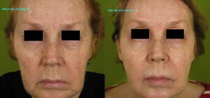 Combination-IPL-Soft-Lift-Full-Face-223-J-bar