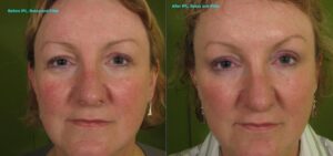 IPL for Rosacea