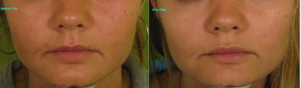 Dermal-Filler-Lips-384-W