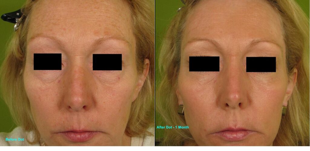 Dot-Fractional-Resurfacing-Full-Face-273-E-bar