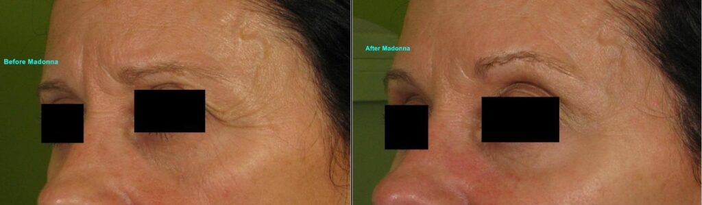 Dot-Fractional-Resurfacing-Madonna-Eyes-Left-336-P-left-bar