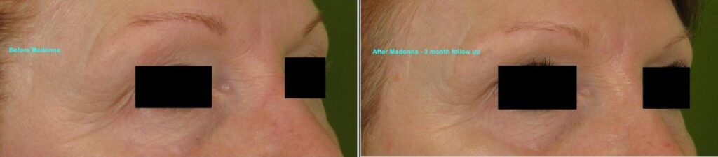 Dot-Fractional-Resurfacing-Madonna-Eyes-Right-179-T-bar