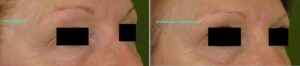 Dot-Fractional-Resurfacing-Madonna-Eyes-Right-179-T-bar