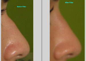 Filler-207-L