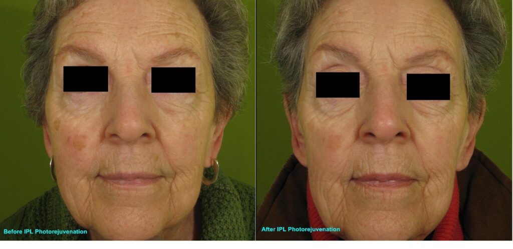 IPL-Full-face-Photorejuvenation-Pigment-142-A-bar