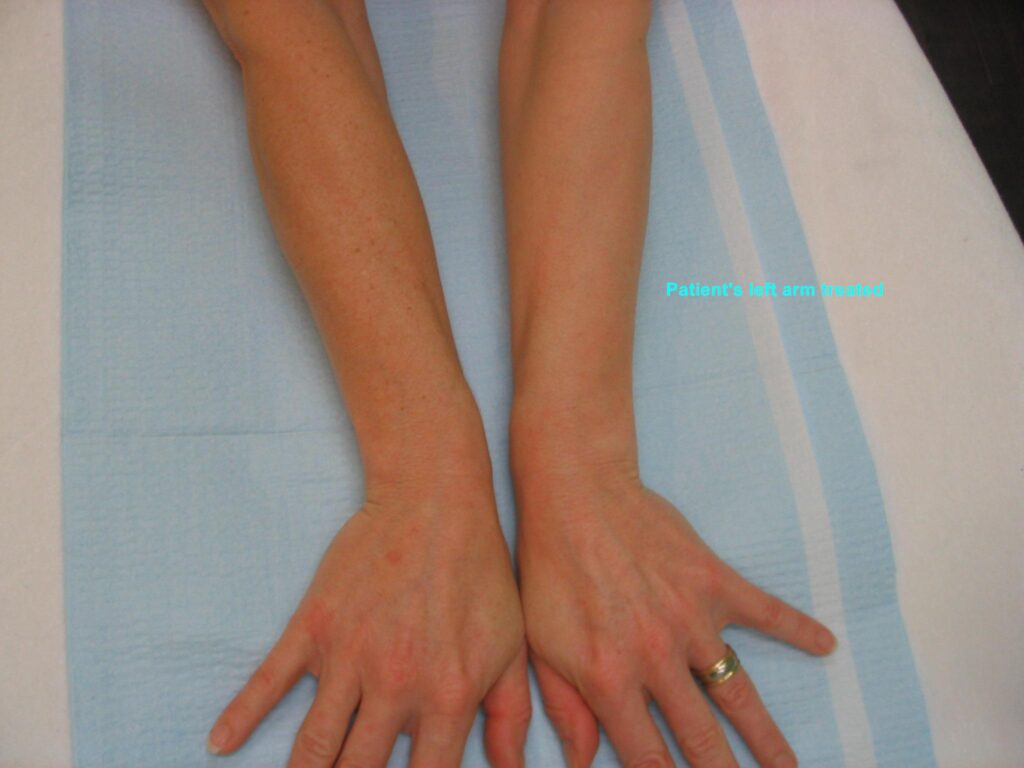 IPL-Photorejuvenation-Pigment-Hands-Arms-450-S