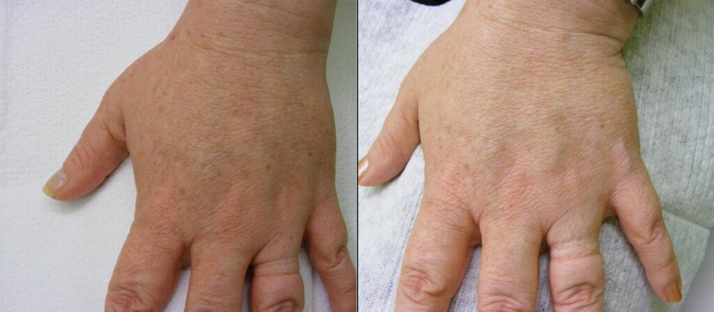 IPL-Photorejuvenation-Pigment-Left-Hand-358-P