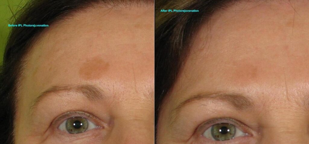 IPL-Photorejuvenation-Pigment-Partial-Forehead-119-B