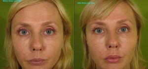 Soft-Lift-4-W-e1347489493551