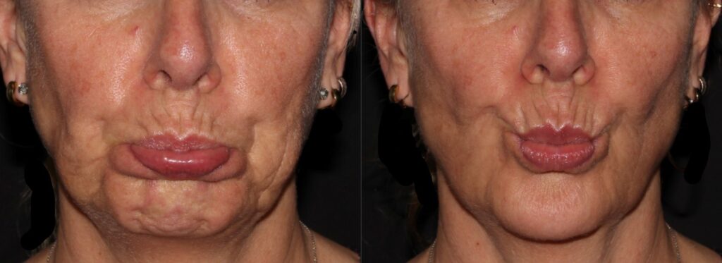 Botox reduces chin pebbling