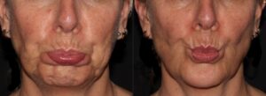 Botox reduces chin pebbling