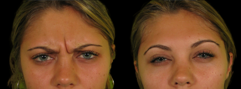 Botox to relax glabellar lines