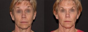Botox relaxes forehead lines