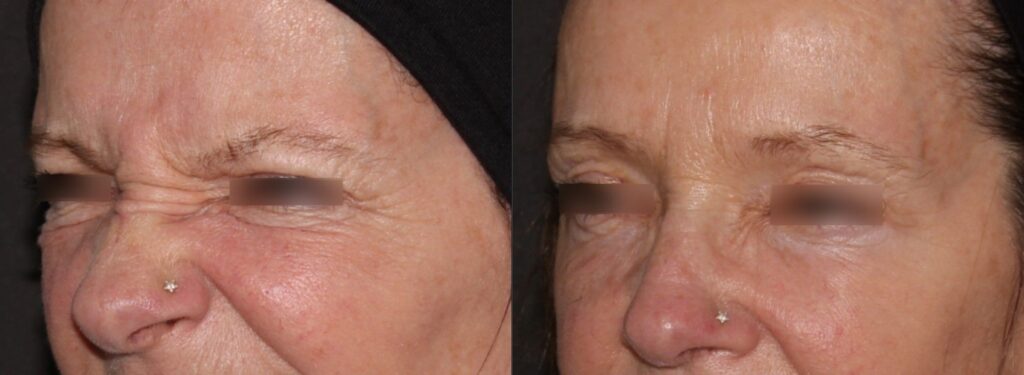 Botox to soften lines