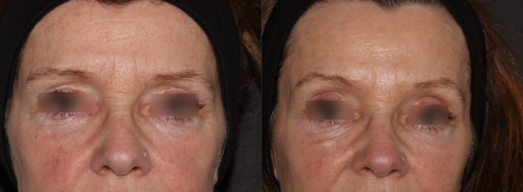 Botox lifts the brow