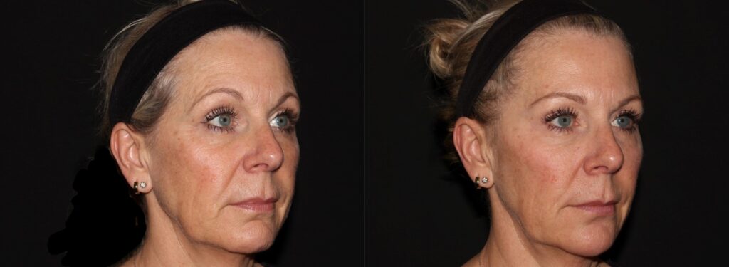 Softlift Facial Rejuvenation