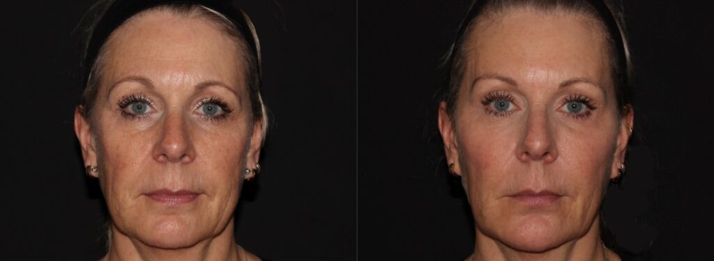 Woman with overall improvement in appearance looking less tired and sad