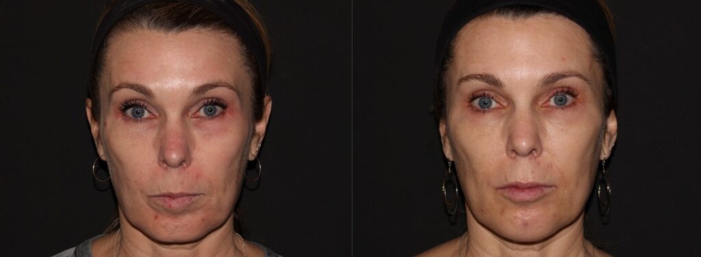Womans photos after receiving Botox and Juvederm