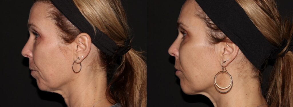 Woman has improved profile, chin proportion, contours and lifts sagging neck