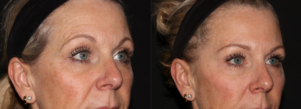 Botox - Brow lift