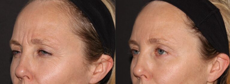 Botox - Smooths crows feet