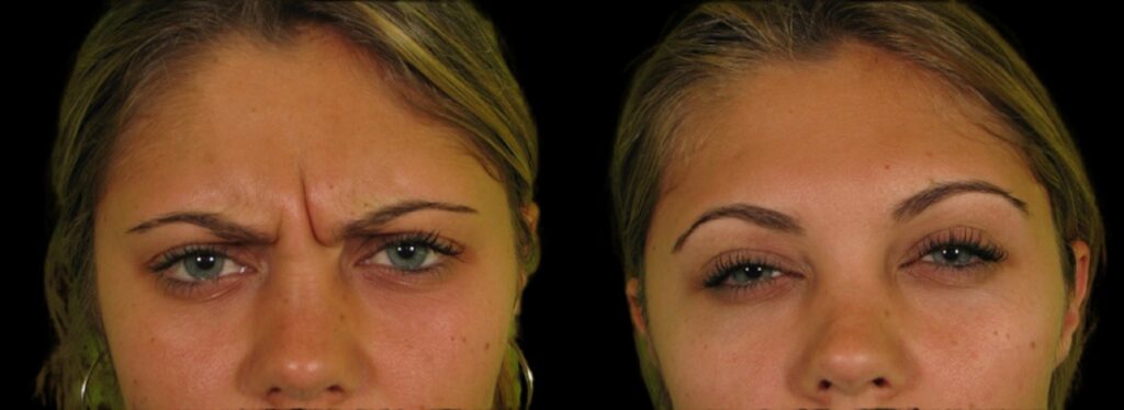 Botox - glabellar lines