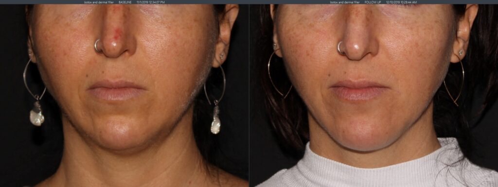 Dermal filler chin, botox brow lift