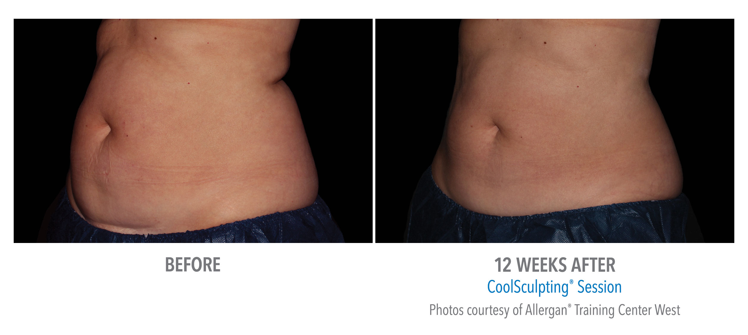 LiveYoung_CoolSculpting_BeforeAfter1