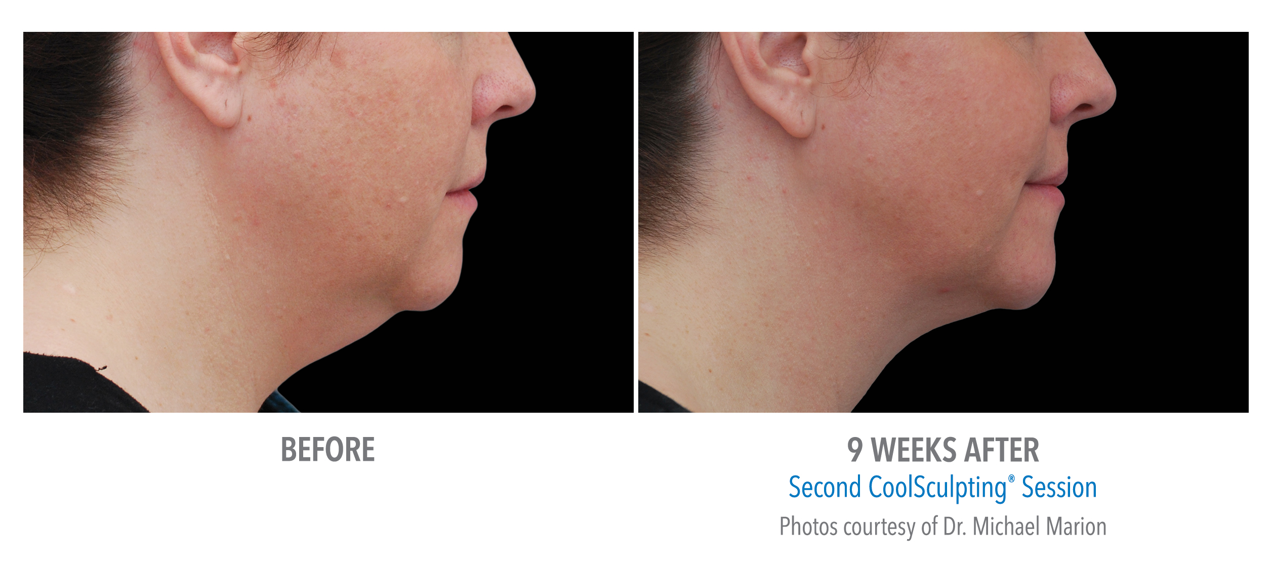 LiveYoung_CoolSculpting_BeforeAfter10