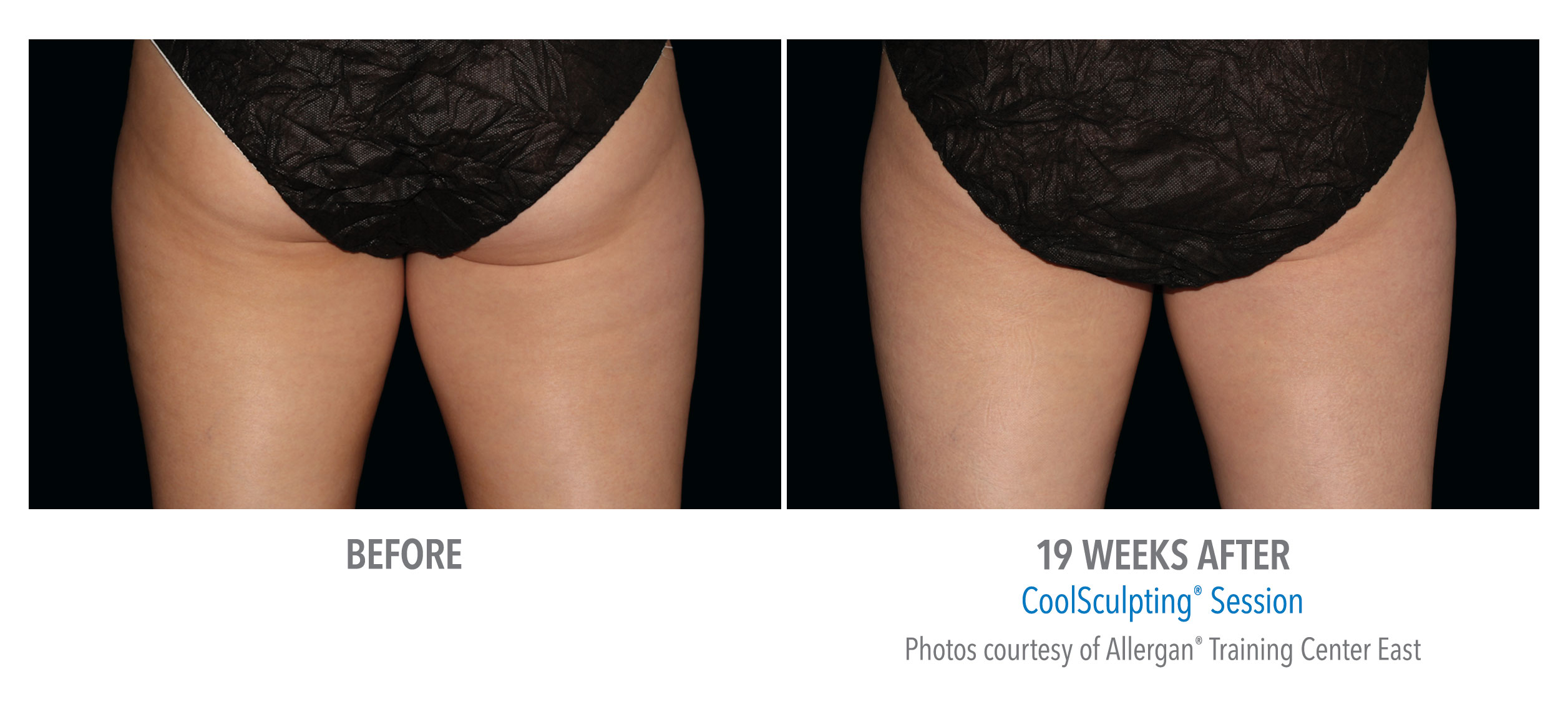 LiveYoung_CoolSculpting_BeforeAfter11