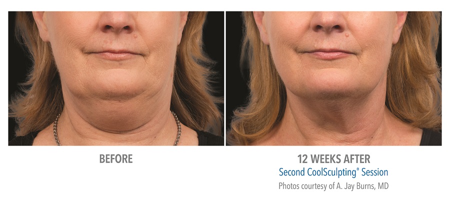 LiveYoung_CoolSculpting_BeforeAfter12