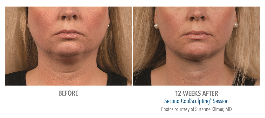LiveYoung_CoolSculpting_BeforeAfter13