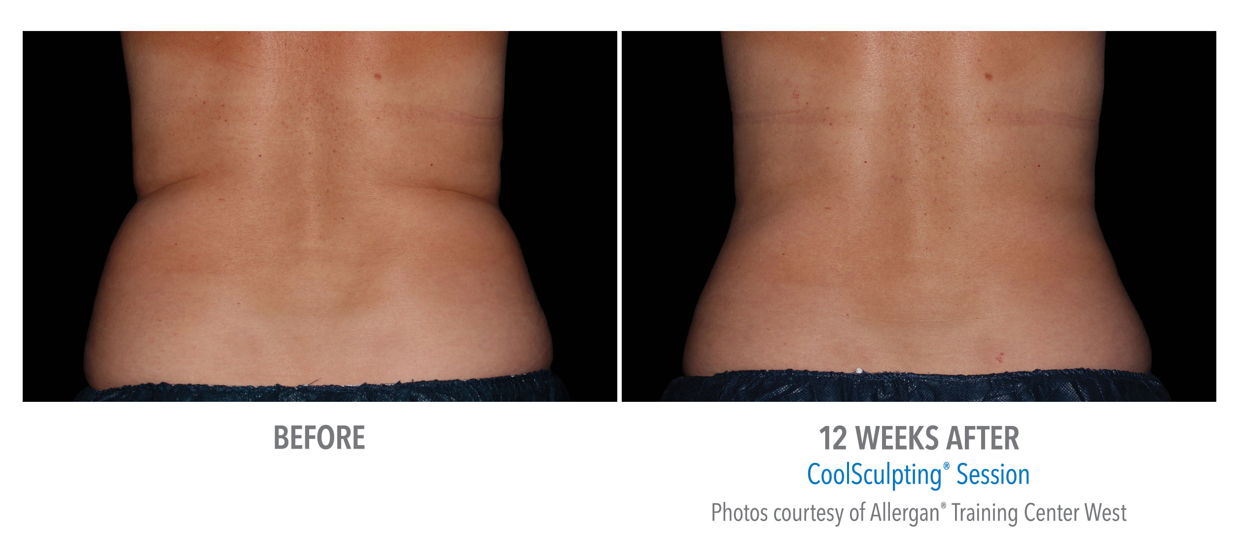 LiveYoung_CoolSculpting_BeforeAfter2