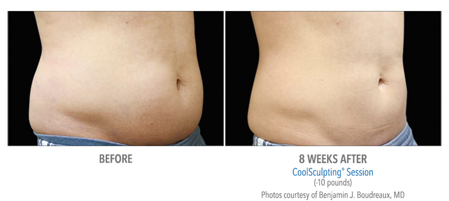 LiveYoung_CoolSculpting_BeforeAfter3