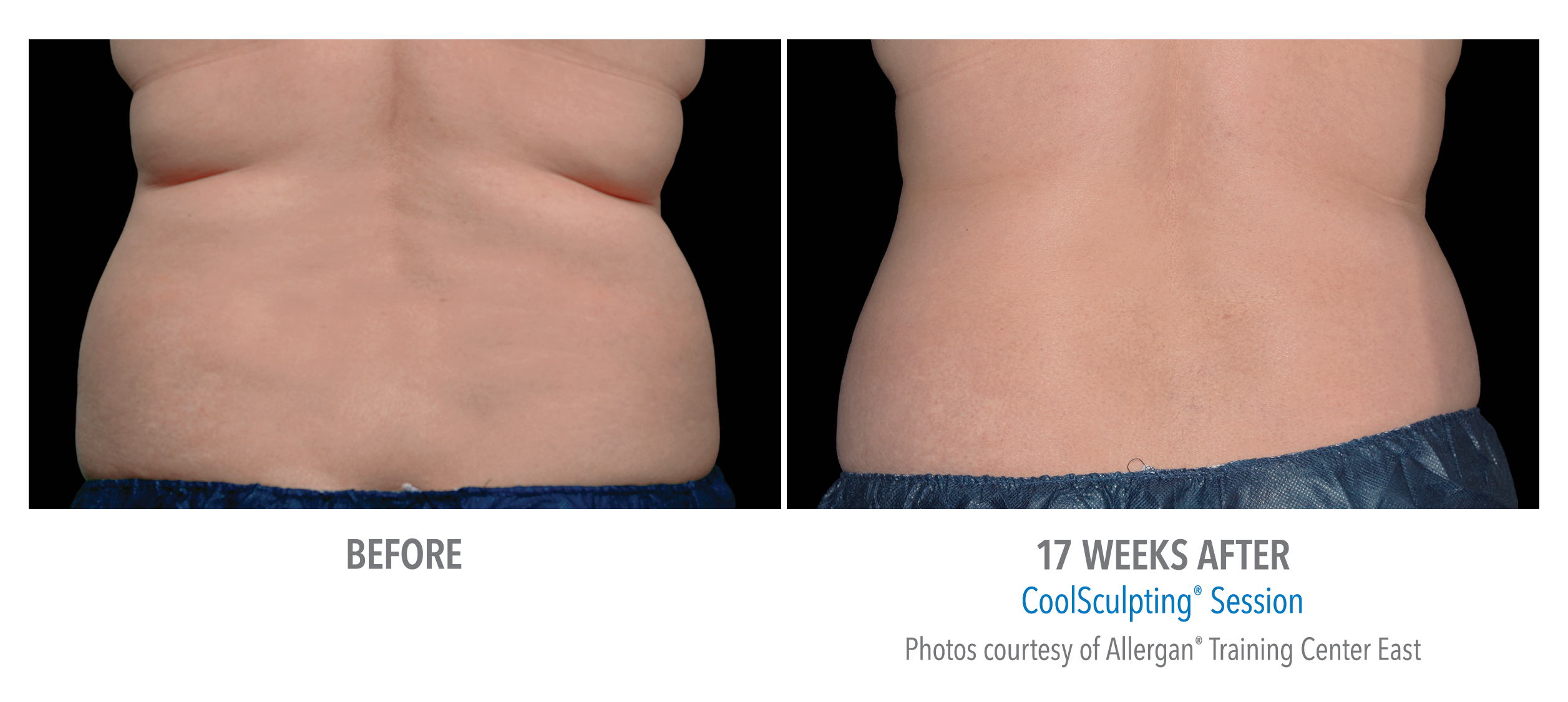 LiveYoung_CoolSculpting_BeforeAfter4