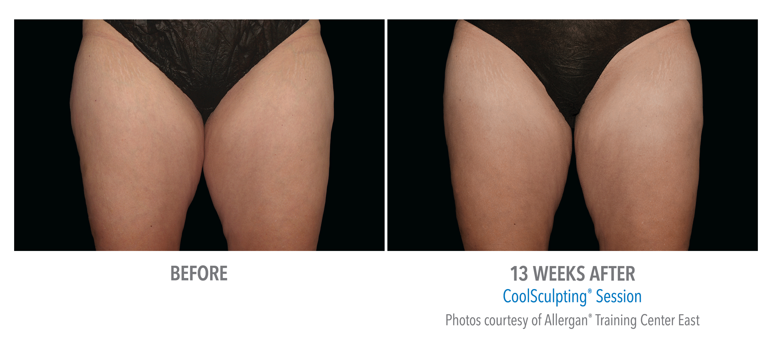 LiveYoung_CoolSculpting_BeforeAfter5