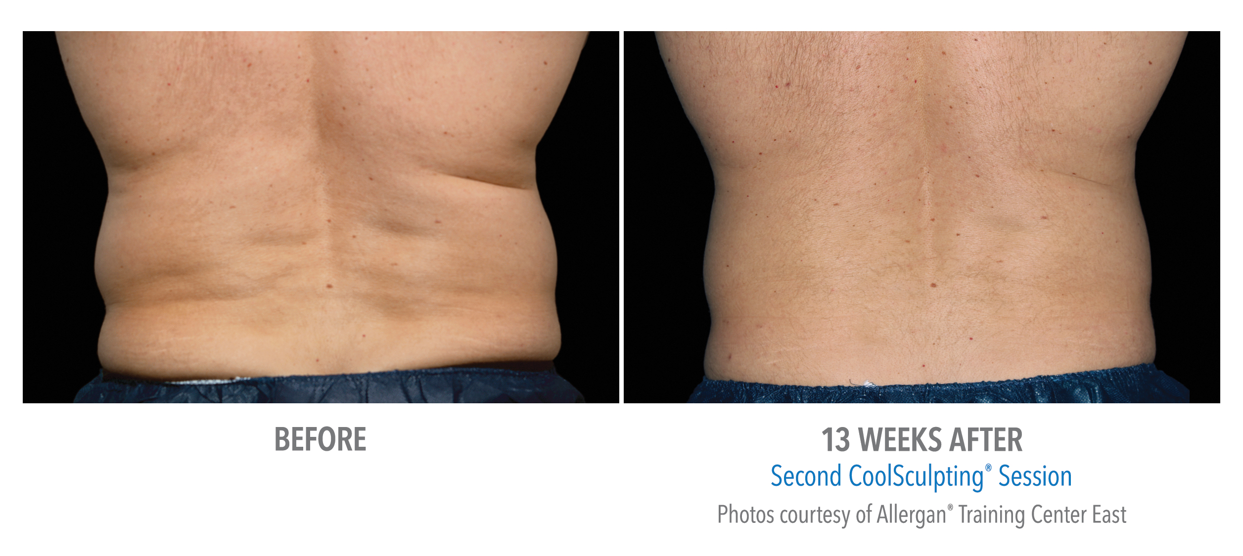 LiveYoung_CoolSculpting_BeforeAfter6