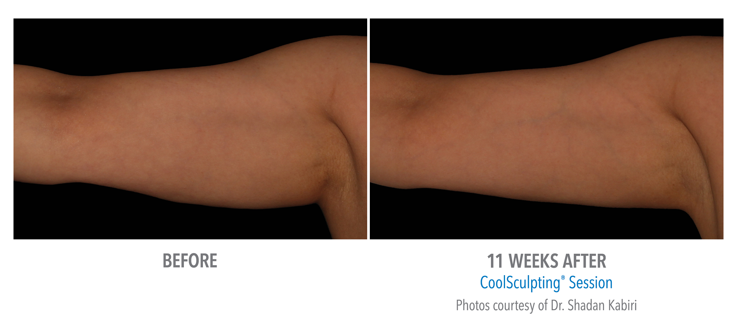 LiveYoung_CoolSculpting_BeforeAfter7