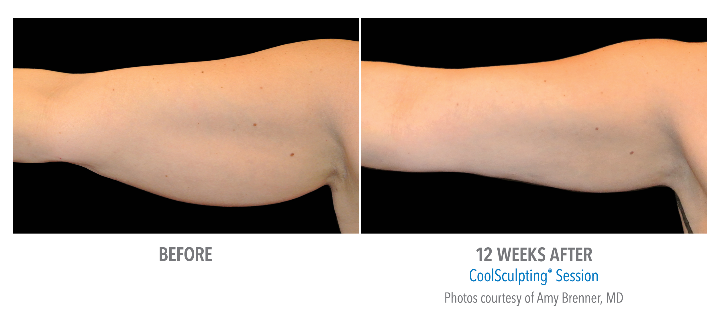 LiveYoung_CoolSculpting_BeforeAfter8